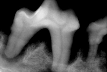 重度歯周病例